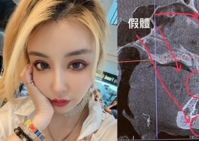 '성형수술 19번' 얼굴 나사 때문에 공항검색대 걸린 모델