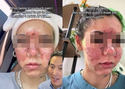 유통기한 지난 화장품, 함부로 쓰면 이렇게 됩니다