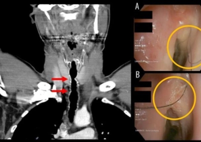 30년 흡연자, 몸 안좋아 병원갔더니 "목 안에 털이 있어요"