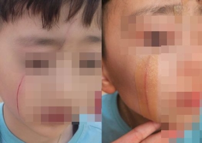 "학원간 초 2아들, 고학년이 연필로 얼굴 긁어"…학부모 분통