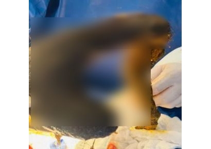 '복통호소' 여성 뱃속에 1㎏ 머리카락 뭉치 발견…원인은 이 병 때문