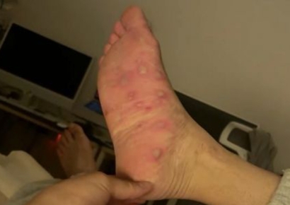 "수포 퍼지고 손·발톱 빠져"…아들에게 옮은 수족구병에 응급실행