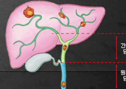 한국이 '세계 발병률 2위'…소리없이 찾아오는 담도암 [콕!건강]
