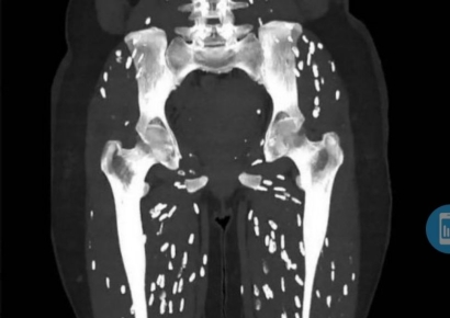 "가장 끔찍한 CT영상"…다리에 '쌀알 모양 기생충' 득실 왜?