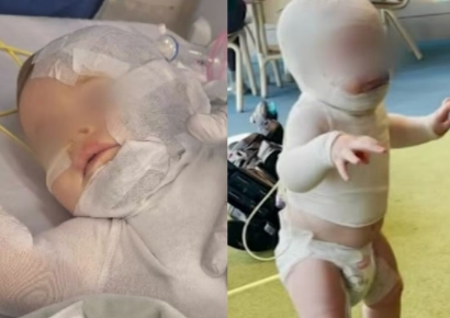 9개월 아기에 뜨거운 커피 붓고 도망… 전신 화상