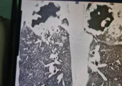 "친구집서 물 잘못 마셨다가…폐 망가지고 매일 알약만 16개 먹어"