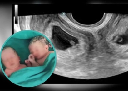 "100만분의 1 확률"…두 개 자궁서 아들·딸 쌍둥이 낳은 중국 여성