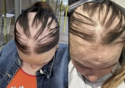 "갑자기 원형탈모 왔다"…20대 여성 '코로나' 여러 번 걸린 탓 주장