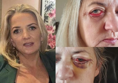 "예뻐지려 한 건데…흉측하게 변해" 눈 밑 지방 제거 부작용 '충격'