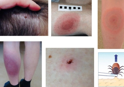 [뉴스속 용어]제2의 에이즈 ‘라임병’