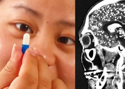 살 좀 빼려고 '이 약' 먹었다가 기억 잃었다…끔찍한 부작용 겪은 여성