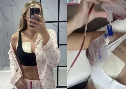 샤워 중 ‘이 증상’ 있다면 유방암 의심…26세에 왼쪽가슴 절제한 여성