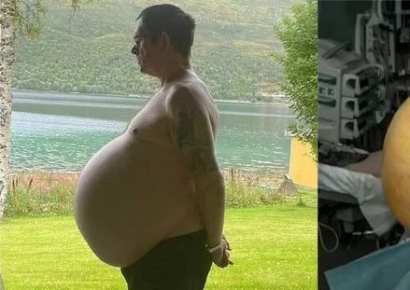 얼굴은 홀쭉한데 남산만한 배…비만인 줄 알았는데 50㎝ 거대 악성종양