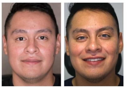 '렌즈 착용한 줄' 인상 확 달라져…美, 눈동자 색 바꾸는 수술 인기