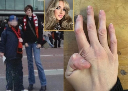 키가 너무 빨리 자란 여성…사지 불균형에 손가락도 굽어