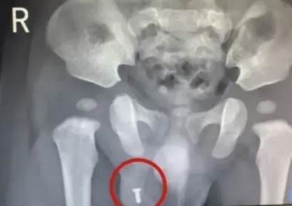 생후 8개월 아이가 삼킨 나사못, 음낭서 발견…中서 수술로 제거