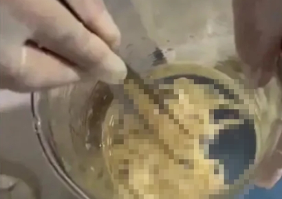 "가려워 미치겠어" 병원 간 中 여성…10m 이것 나오자 '경악'