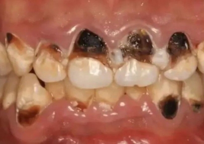 매일 콜라 5병 마신 여성, 1년 후 치아 상태 '경악'