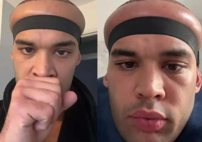 "유명 래퍼도 심었다더니…모발이식 부작용에 머리가 풍선됐어요"