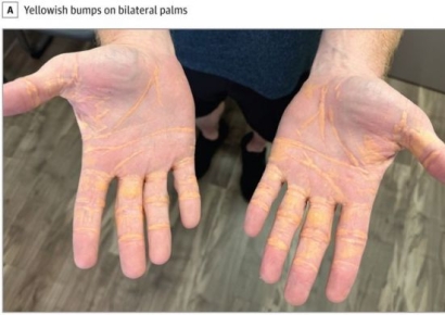 다이어트 효과 있다고 좋아했는데…매일 치즈 먹고 생긴 충격적인 변화