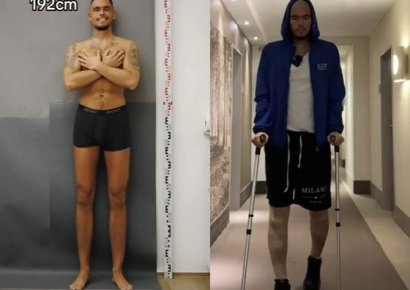 "키 작다고 따돌림 받아서"…사지연장술로 '171→192㎝'된 남성
