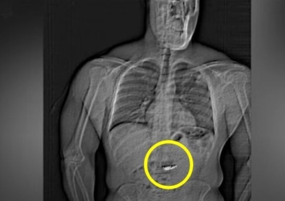 "화장실 언제 갈거야?"…11억 짜리 귀걸이 삼킨 강도에 애타는 경찰