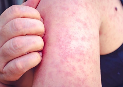 "출국 전 예방접종하세요" 공기로 전파되는 '이 병'…전 세계 덮쳤다