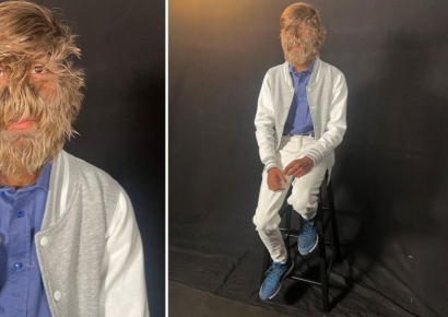 "지금 모습 그대로 살래요"…기네스북 오른 인도 '늑대소년'