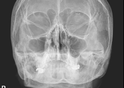 두통 호소한 환자 머릿속 하얀 이물질 '경악'…"한국인에게 흔해"
