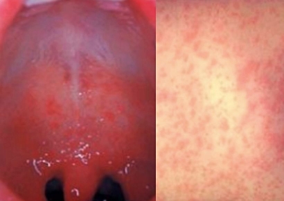 베트남 가는데 어떡하나…4만명 감염·5명 사망 바이러스 확산