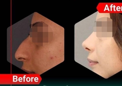 "수술 후 수입 3배 증가, 지위도 높아져"…수십만 여성, 성형 열풍 부는 나라