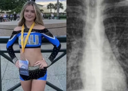 "숨을 못 쉬겠어요" 치어리더 활동하던 딸 '팝콘 폐' 진단 …엄마 "전자담배 때문" 절규