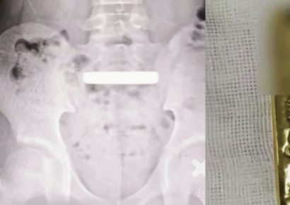 100g 골드바 삼킨 中 소년…화장실서 내보내려다 결국