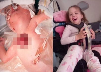 "심장이 몸 밖으로 나온 채 태어나"…영국 소녀 7년 만에 재건 수술