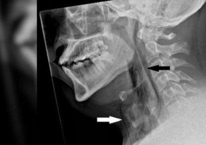 "재채기는 참을 수 없다더니"…억지로 참은 남성 목에 생긴 '이것'