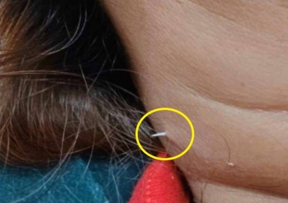 병원 가서도 못 빼낸 생선 가시…2주 만에 목 뚫고 나와