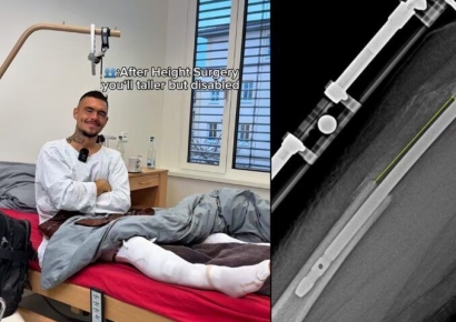 "극심한 고통 견뎌"…연장 수술로 키 23㎝ 늘린 남성 화제