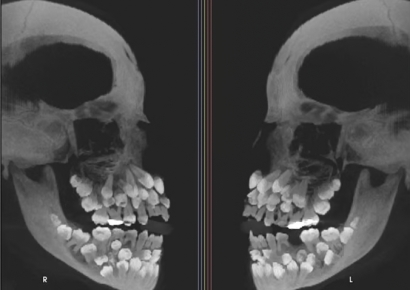 치아 81개, 입 속에서 '6층집' 지었다…11세 소녀에 학계마저 '화들짝'