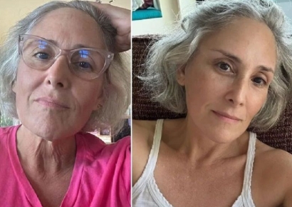 안면거상술 받은 60세 여성의 충고 "이거 했더라면…"