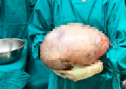 "많이 먹어서 살찐 게 아니었어?"…배에서 나온 8kg짜리의 정체 