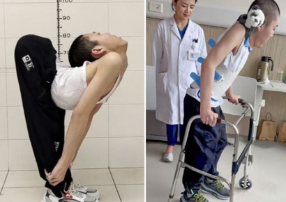 허리 180도 꺾인 소년 마침내 바로 섰다…"기적 같은 소식" 中 전역 감동 물결