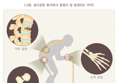 "야식 먹을까" 사소한 습관이 골절까지…日 연구진 '경고'