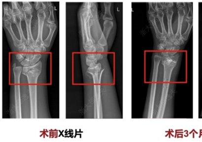 3분 만에 부러진 뼈 붙었다…의료용 접착제 개발