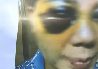 "중국서 성형하면 얼굴이 판다 된다?"…부작용 속출 논란