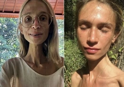 체중 22㎏, 손톱 엉망에 이는 다 썩어…"오직 생과일만 먹는다" 20대 결국 사망