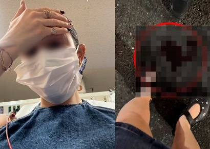 "일본 갔다가 미친 경험"…'도쿄 갱스터' 도심 쥐에 물려 피 흘린 외국인