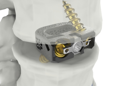 CGBio Medtech's Spinal Implant 'UniSpace' Receives FDA Clearance