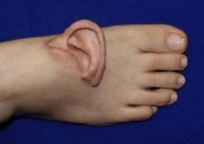 발등에서 귀가 왜 나오는데?…5개월 만에 되돌린 의학의 기적