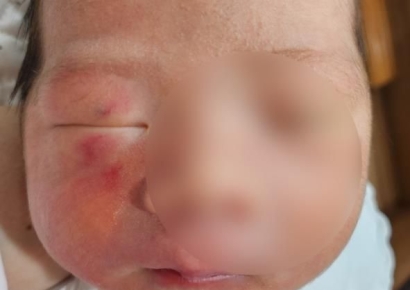 "3시간 전엔 없었어요"…신생아실 있던 '생후 4일' 아이 얼굴에 상처