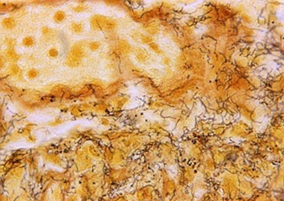 "젊은 남성들 특히 조심" 어느새 1만명 넘게 감염…매독, 다시 고개